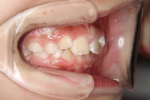 前歯の叢生、上顎前突の症例です